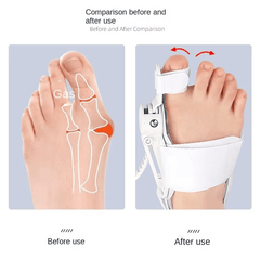 ToeAligner™ — Step Pain-Free and Shine with Perfectly Straight Toes