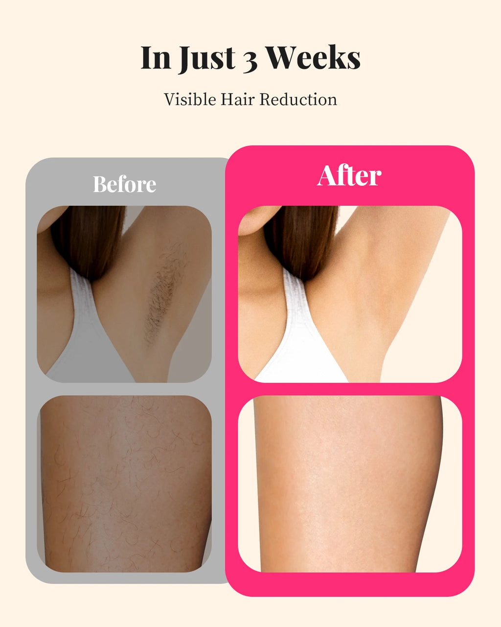 IPL Hair Removal Device for Body, Bikini & Face – 990,000 Flashes