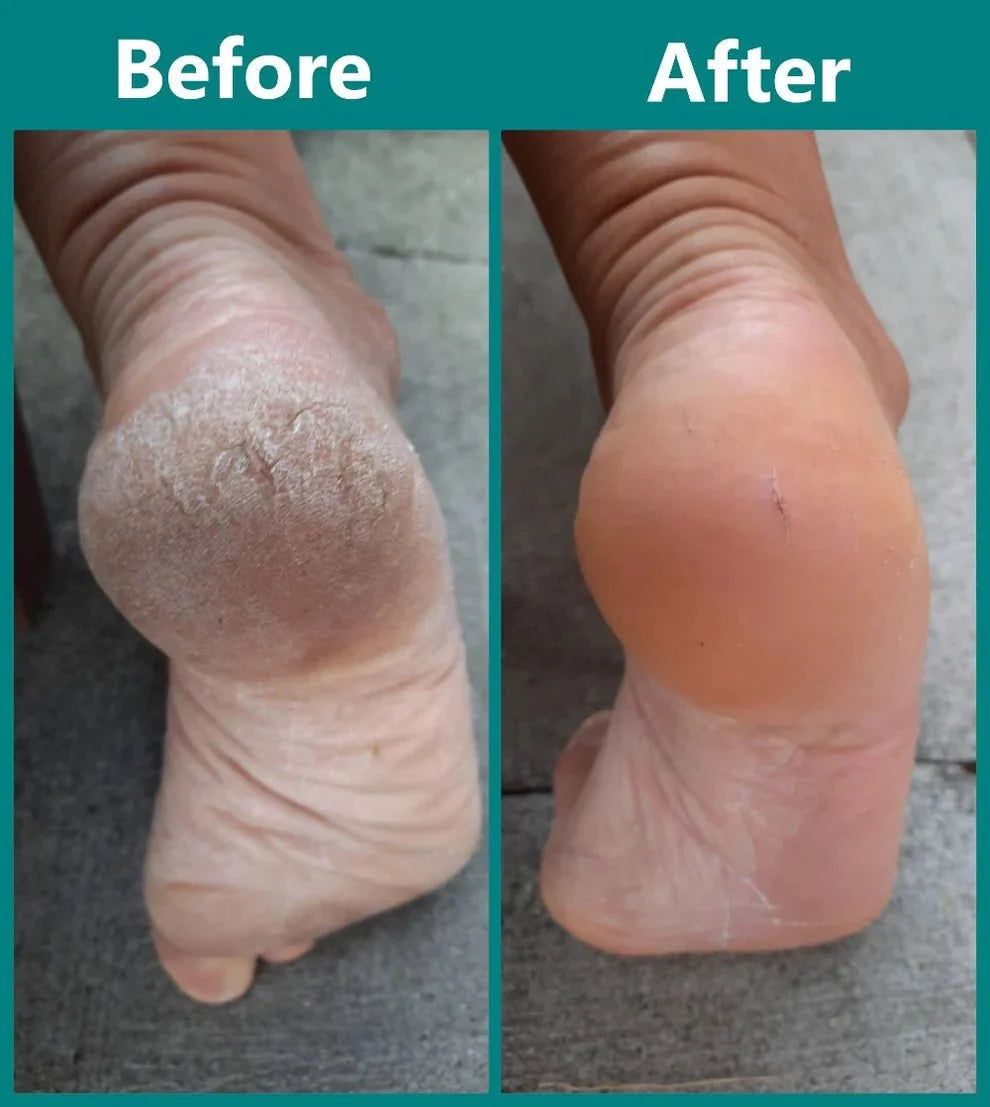 Foot Care Device for Gentle Exfoliation | Waterproof with Dual Roller Strength and 100-Minute Battery Life 
